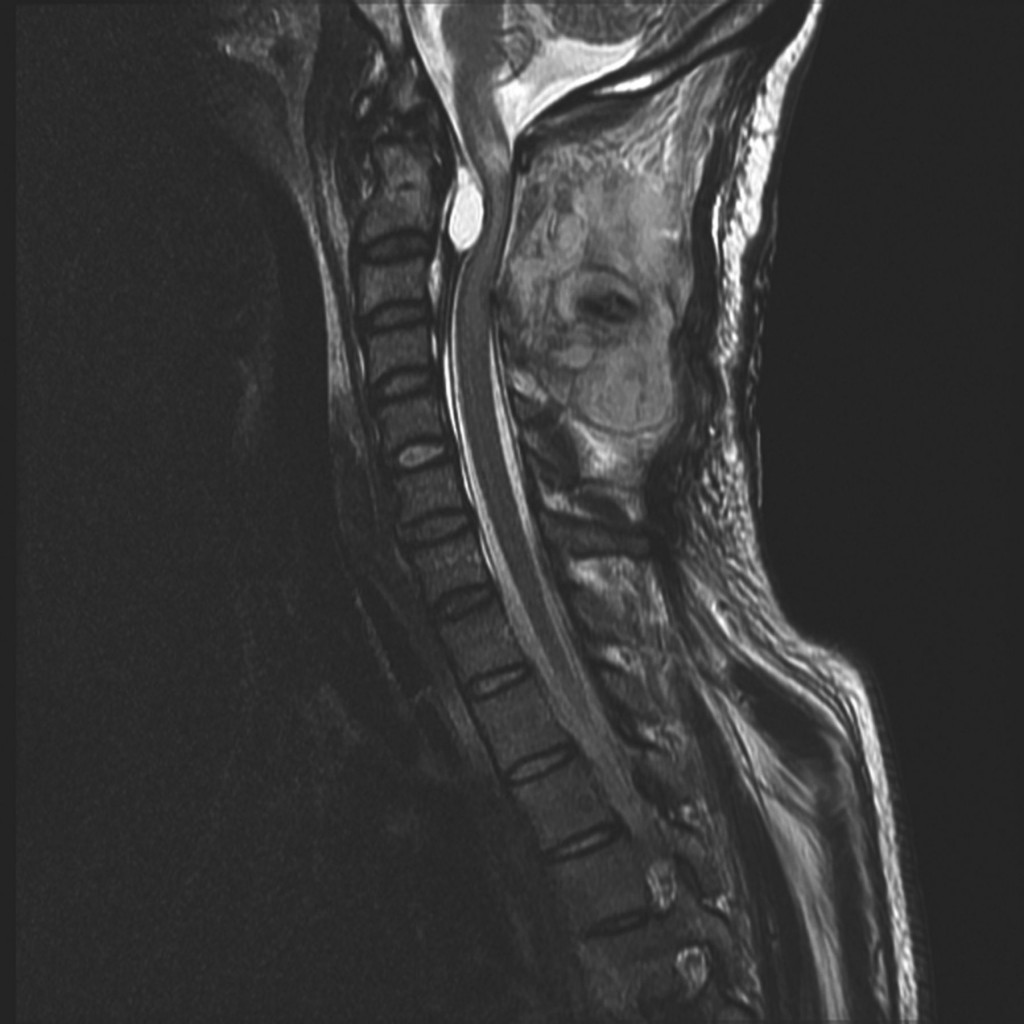 A Thirty-two-year-old Man With Neck Pain Following Extension Injury 