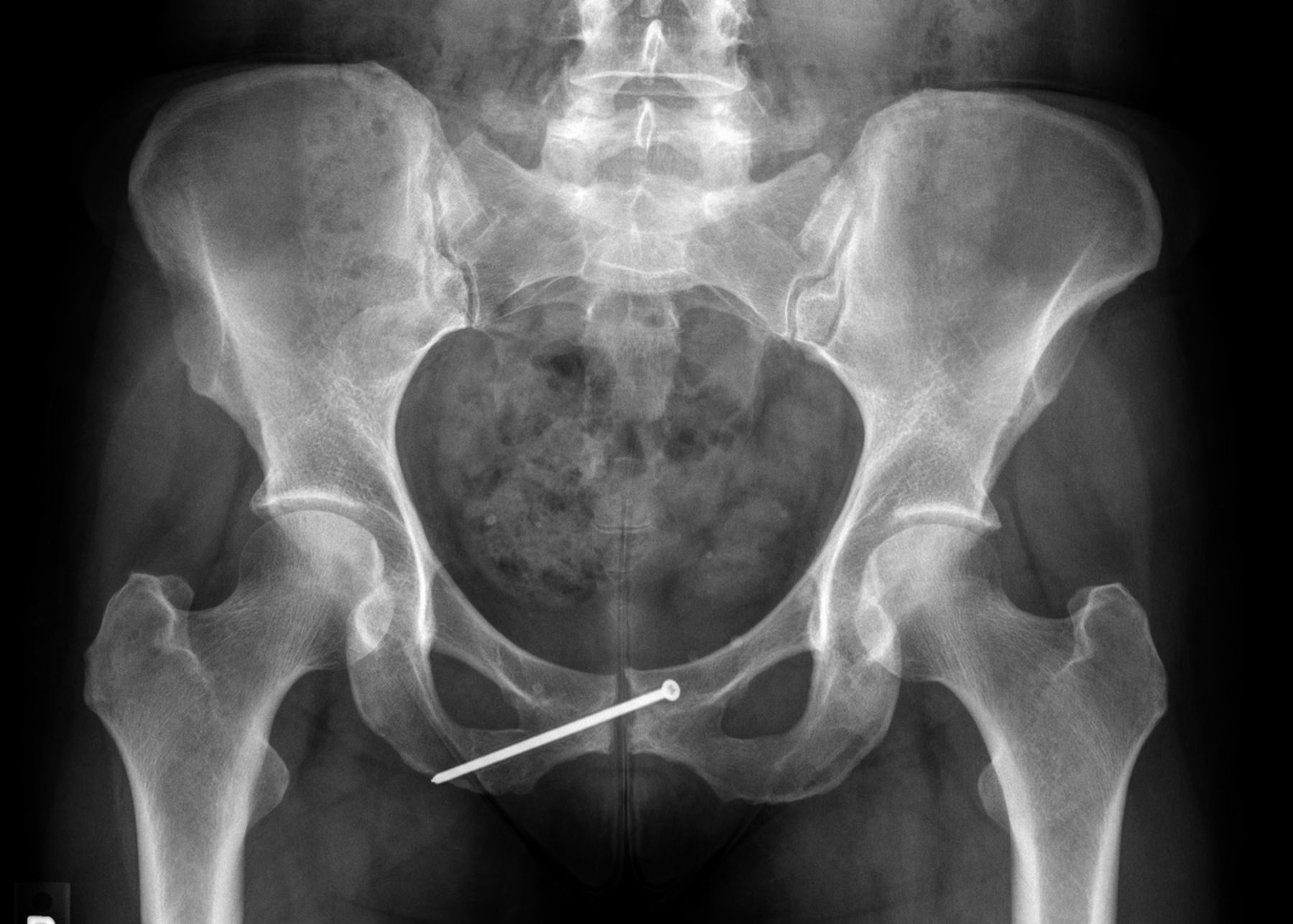 inferior-pubic-ramus-fracture-what-is-a-ramus-with-pictures-we