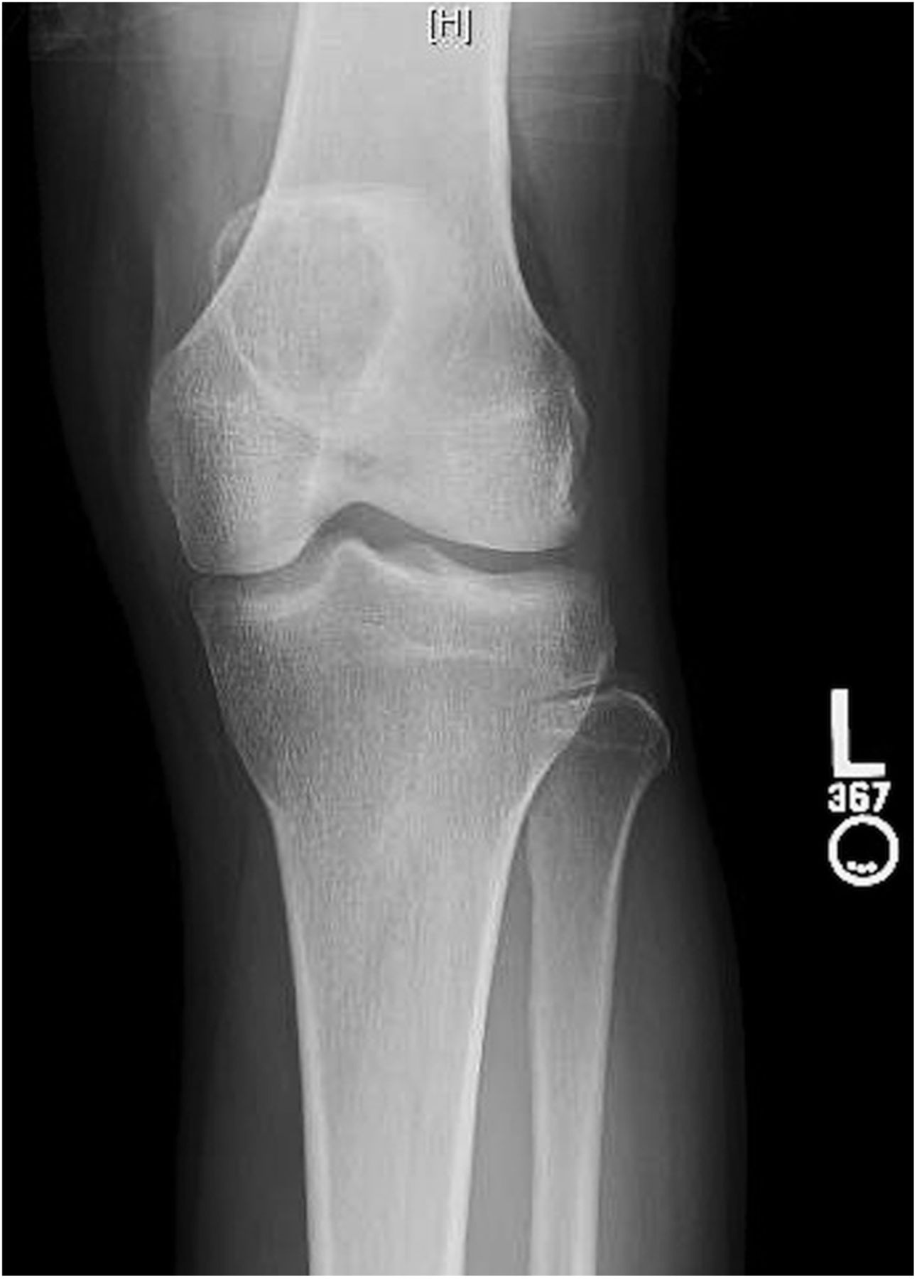 A 33-Year-Old Man with Left Knee Pain - JBJS Image Quiz