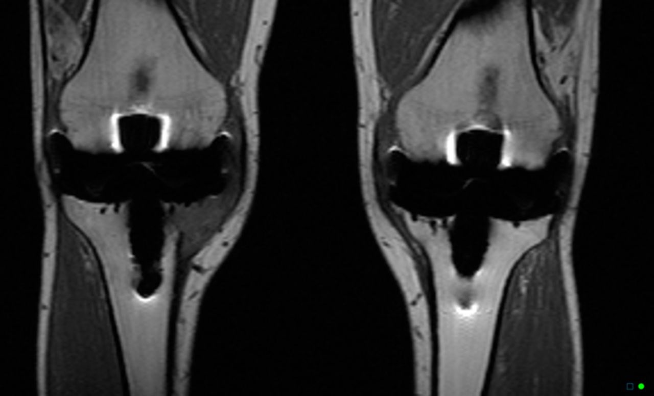 Can You Have Mri After Joint Replacement