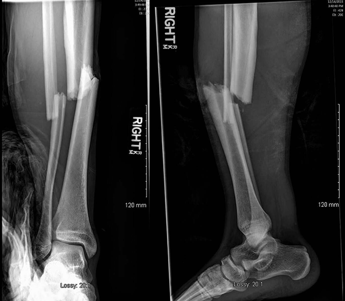 comminuted fracture tibia and fibula