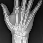 Fig. 1-A Anteroposterior radiograph of the hand that was made on the day of injury.
