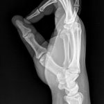 Fig. 1-C Lateral radiograph of the hand that was made on the day of injury.
