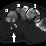 Fig. 2-A Axial CT image reveals the presence of a comminuted fracture (arrow). H = hamate, C = capitate, and S = scaphoid.
