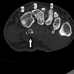 Fig. 2-C Axial CT image reveals the presence of a comminuted fracture (arrow). H = hamate, C = capitate, and S = scaphoid.

