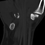 Fig. 2-E Coronal CT image reveals the presence of a comminuted fracture.

