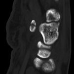 Fig. 2-F Sagittal CT image reveals the presence of a comminuted fracture.
