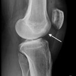 Fig. 7 Lateral radiograph demonstrating postsurgical changes. The arrow indicates the osteochondral allograft plug placed at the recipient site.
