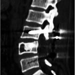 Fig. 5 At the 2-year follow-up, the CT scan showed residuum in the anterior part of the vertebra without involvement of the adjoining bone or progression to encompass the bone grafts.
