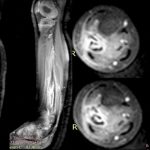 Fig. 2 Intravenous-contrasted MRI showed heterogeneous contrast in the distal metadiaphyseal region of the fibula.
