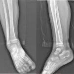 Fig. 5 Recession in pathologic signs on radiograph after 6 months.
