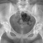 A 12-Year-Old Girl with Hip Pain