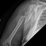 Fig. 1-A Anteroposterior radiograph showing substantial displacement of a proximal humeral shaft fracture.
