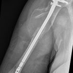 Fig. 1-C Anteroposterior radiograph at 6 weeks postoperatively showing adequate fracture alignment and an intact intramedullary humeral nail.
