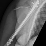 Fig. 1-D Lateral radiograph at 6 weeks postoperatively showing adequate fracture alignment and an intact intramedullary humeral nail.
