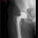 Fig. 2 Anteroposterior radiograph of the right hip at 4 weeks after the trauma.
