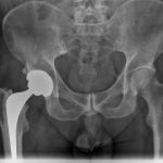 Fig. 6 Anteroposterior radiograph of the pelvis following the revision arthroplasty.
