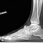 Fig. 5 A different patient with Charcot arthropathy with notable findings of midfoot collapse, midfoot arthritis, and heterotopic ossification and fragmentation.
