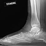 A 58-Year-Old Man with Foot Numbness Following a Car Accident