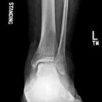 Fig. 2-B Ankle radiograph showing diffuse swelling and osteopenia, mild contour deformity of the lateral talar dome, and increased talar sclerosis.
