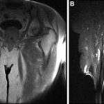 Fig. 3 Coronal T1-weighted (Fig. 3-A) and sagittal STIR (Fig. 3-B) MRI scans of the right femur show heterogeneous signal within the lesion. There are rounded areas in the bone on the coronal T1-weighted image that are isointense with fat. The lesion has a high signal on fluid-sensitive sequences.
