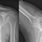 A 56-Year-Old Woman with Progressive Shoulder Pain