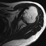 Fig. 3 Axial T2-weighted MRI of the left shoulder at presentation.
