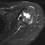 Fig. 4 Axial, short tau inversion recovery (STIR) MRI of the left shoulder at presentation.
