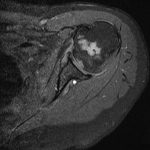 Fig. 5 Axial, T1-weighted, fat-saturated MRI of the left shoulder at presentation.
