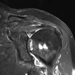 Fig. 7 Coronal, T1-weighted MRI of the left shoulder at presentation.

