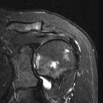 Fig. 8 Coronal, STIR MRI of the left shoulder at presentation.

