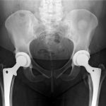 Fig. 1 Anteroposterior pelvic radiograph 8 years postoperatively after left total hip arthroplasty.
