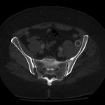 Fig. 2-B Pelvic axial CT scan obtained 8 years postoperatively after left total hip arthroplasty.
