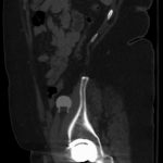 Fig. 2-D Pelvic CT scan obtained 8 years postoperatively after left total hip arthroplasty showing sagittal projection.
