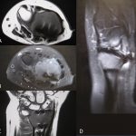 Fig. 3 MRI of distal part of the radius in 2011 for further evaluation of the lesion: axial views, T1-weighted (Fig. 3-A) and T2-weighted (Fig. 3-B); coronal view, T1-weighted (Fig. 3-C); and sagittal view, T2-weighted (Fig. 3-D).
