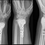 Fig. 6 Two-year postoperative radiographs of left distal part of the radius. Intact implant and bone cement without signs of tumor recurrence.
