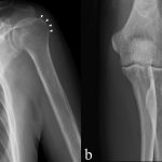 A 70-Year-Old Man with Shoulder and Elbow Pain