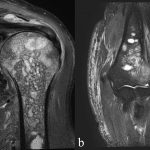 Fig. 2 : Fat-suppression MRI scans of multiple round lesions in the proximal epiphysis (Fig. 2-A) and the distal epiphysis (Fig. 2-B).
