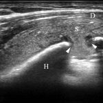 Fig. 4 Ultrasonography depicting a defect of the humeral head (discontinuity of the cortical bone between the white arrowheads) and the outflow of the fluid from the bone marrow. D = deltoid muscle, H = humeral head, and S = subacromial bursa.

