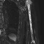 Fig. 5 Fat-suppression MRI scan of the diffuse high-signal change with multiple, circular, low-signal areas in the humerus of the diaphysis, metaphysis, and epiphysis of the proximal and distal ends.
