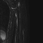 Fig. 9 Fat-suppression MRI scan showing a decrease in diffuse high-signal changes.
