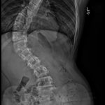Fig. 1 Standing posteroanterior scoliosis radiograph of a 14-year-old girl with adolescent idiopathic scoliosis showing an 82° right-sided main thoracolumbar curve and 5 lumbar vertebrae.
