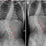 Fig. 2 Radiographs of the patient, in which the major thoracolumbar curve reduces to 58° with traction. Fig. 2-A The original traction radiograph in which a stitching error mechanically but neatly eliminated 1 lumbar vertebra. Fig. 2-B The corrected traction radiograph showing all 5 lumbar vertebrae.
