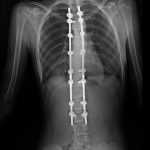 Fig. 3 Six-week postoperative anteroposterior radiograph showing the surgical correction of scoliosis.
