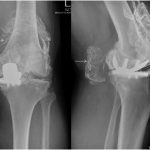 Fig. 2 Radiographs at 4 weeks showing metallosis and radiolucent spacer in the metal arthrogram, shown by the white arrows: anteroposterior view (left), and lateral view (right).
