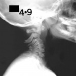 Fig. 1-A Initial radiograph demonstrating an odontoid fracture.
