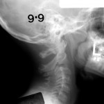 Fig. 1-D Radiograph showing remodeling of the healed fracture at five years.
