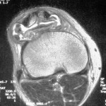 Fig. 3 T2-weighted magnetic resonance image of the knee, showing areas with very high signal intensity in the infrapatellar bursa, suggesting a fluid collection. The bursa contains multiple hypointense nodules.
