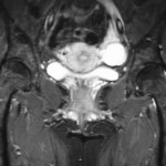 Fig. 1 Fast-spin-echo proton-density-weighted magnetic resonance image with fat suppression, showing tears of the gluteus medius and minimus tendons (arrow), focal edema surrounding the greater trochanteric tendinous insertions, and reactive trochanteric bursitis in the right hip.
