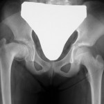 Fig. 1-A An anteroposterior radiograph of the pelvis showing an anterior slip of the right capital femoral epiphysis.
